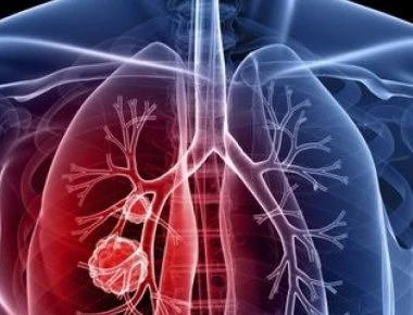 Καρκίνος του πνεύμονα: Σημαντικές εξελίξεις στη θεραπεία του